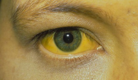 Hepatitis symptoms